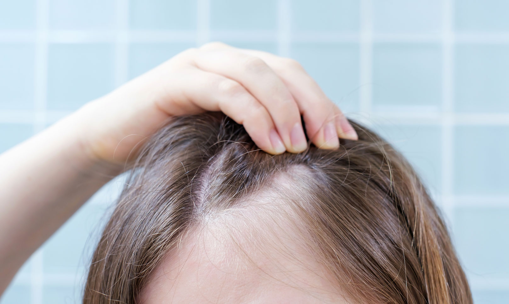 Queda de cabelo após parar o anticoncepcional: é normal?